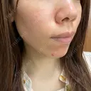 ヴェルヴェットスキン KOBE美容皮膚科 神戸東灘院 DAY 4 サムネイル用
