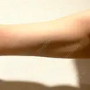 脂肪溶解注射 / その他 HAAB BEAUTY CLINIC 名古屋院 AFTER サムネイル用