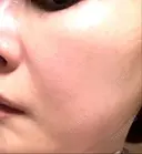 ピコレーザートーニング（美白・肝斑） TCB東京中央美容外科 銀座有楽町院 DAY 4 サムネイル用