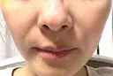 ピコレーザートーニング（美白・肝斑） TCB東京中央美容外科 銀座有楽町院 AFTER サムネイル用