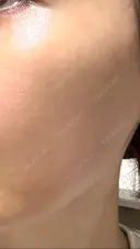 ピコレーザートーニング（美白・肝斑） TCB東京中央美容外科 銀座有楽町院 DAY 7 サムネイル用