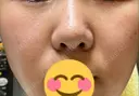 毛穴洗浄（ハイドラフェイシャルなど） ミニマムスキンクリニック銀座 AFTER サムネイル用