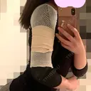 脂肪吸引（二の腕） / 脂肪吸引（肩） 湘南美容クリニック 渋谷院 DAY 2 サムネイル用