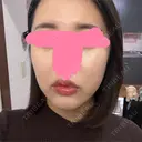 ヒアルロン酸注入（唇） / ボトックス（口角） / ヒアルロン酸注入（頬） KAGA CLINIC AFTER サムネイル用