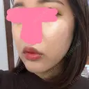 ヒアルロン酸注入（唇） / ボトックス（口角） / ヒアルロン酸注入（頬） KAGA CLINIC DAY 9 サムネイル用