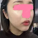 ヒアルロン酸注入（唇） / ボトックス（口角） / ヒアルロン酸注入（頬） KAGA CLINIC DAY 9 サムネイル用