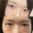 クマ治療 X CLINIC 銀座院 DAY 1 サムネイル用