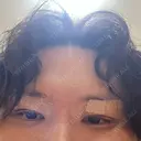 眼瞼下垂（切開） シェリークリニック 福岡院 DAY 0 サムネイル用