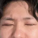 眼瞼下垂（切開） シェリークリニック 福岡院 DAY 1 サムネイル用