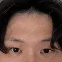 眼瞼下垂（切開） シェリークリニック 福岡院 AFTER サムネイル用