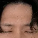 眼瞼下垂（切開） シェリークリニック 福岡院 DAY 22 サムネイル用