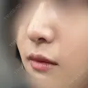 鼻尖形成（切開） / 軟骨移植 / 眉間プロテーゼ / 小鼻縮小（非切開） / 鼻柱下降・鼻唇角形成（猫手術） グローバルビューティークリニック 東京院 DAY 60 サムネイル用