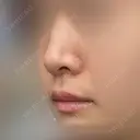 鼻尖形成（切開） / 軟骨移植 / 眉間プロテーゼ / 小鼻縮小（非切開） / 鼻柱下降・鼻唇角形成（猫手術） グローバルビューティークリニック 東京院 DAY 60 サムネイル用