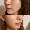 糸リフト / 脂肪吸引注射（顔） 湘南美容クリニック 名古屋栄院 DAY 51 サムネイル用