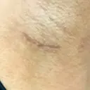 豊胸（シリコン＋脂肪併用） THE ROPPONGI CLINIC（ザ 六本木クリニック） DAY 30 サムネイル用