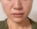 糸リフト / ヒアルロン酸注入（あご） ブルームクリニック（BLOOM CLINIC） DAY 6 サムネイル用