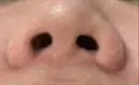 小鼻縮小（切開） くさのたろうクリニック DAY 15 サムネイル用
