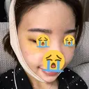 脂肪吸引（顔） / 額を丸く / 脂肪吸引（脚） / こめかみ形成 / 輪郭修正 / 脂肪注入（額） / 脂肪注入（輪郭） フレッシュ整形外科 DAY 9 サムネイル用