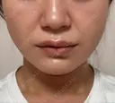 糸リフト / ヒアルロン酸注入（あご） ブルームクリニック（BLOOM CLINIC） DAY 10 サムネイル用