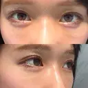 クマ治療 X CLINIC 銀座院 DAY 10 サムネイル用