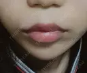 ヒアルロン酸注入（あご） / ボトックス（エラ・小顔） / ヒアルロン酸注入（唇） TCB東京中央美容外科 郡山院 DAY 1 サムネイル用