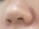 小鼻縮小（切開） くさのたろうクリニック DAY 19 サムネイル用