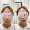 ハイフ（顔） 日本ウェルネス再生クリニック AFTER サムネイル用