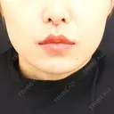 小鼻縮小（切開） / 人中短縮 / 鼻翼挙上 / 口角挙上 Otus Clinic 【オータスクリニック】 AFTER サムネイル用
