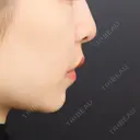小鼻縮小（切開） / 人中短縮 / 鼻翼挙上 / 口角挙上 Otus Clinic 【オータスクリニック】 DAY 95 サムネイル用