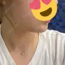 ヒアルロン酸注入（あご） ヴェリテクリニック 大阪院 DAY 7 サムネイル用