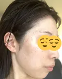 シミ取りレーザー Mavie Beauty Clinic （マヴィービューティークリニック） DAY 3 サムネイル用