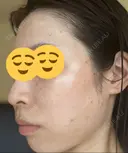 シミ取りレーザー Mavie Beauty Clinic （マヴィービューティークリニック） DAY 3 サムネイル用