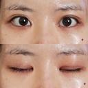 目頭切開 / 目尻切開 / 水光注射（ハリ・美肌） エートップ美容整形外科 DAY 21 サムネイル用