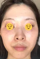 シミ取りレーザー Mavie Beauty Clinic （マヴィービューティークリニック） DAY 4 サムネイル用