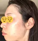 シミ取りレーザー Mavie Beauty Clinic （マヴィービューティークリニック） DAY 4 サムネイル用