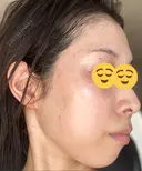 シミ取りレーザー Mavie Beauty Clinic （マヴィービューティークリニック） DAY 4 サムネイル用