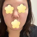 隆鼻術 / 鼻尖形成（切開） / 軟骨移植 エースクリニック 名古屋院 DAY 7 サムネイル用