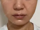 糸リフト / ヒアルロン酸注入（あご） ブルームクリニック（BLOOM CLINIC） DAY 17 サムネイル用