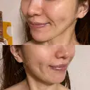 糸リフト / 脂肪吸引注射（顔） 湘南美容クリニック 名古屋栄院 DAY 63 サムネイル用