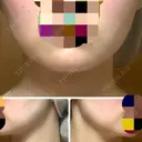 ボトックス（エラ・小顔） TCB東京中央美容外科 大宮東口院 AFTER サムネイル用