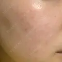 ピーリング（ニキビ・毛穴） まゆりなclinic 名古屋栄 DAY 3 サムネイル用