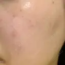 ピーリング（ニキビ・毛穴） まゆりなclinic 名古屋栄 DAY 4 サムネイル用