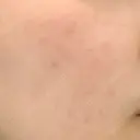 ピーリング（ニキビ・毛穴） まゆりなclinic 名古屋栄 AFTER サムネイル用