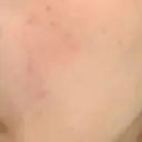 ピーリング（ニキビ・毛穴） まゆりなclinic 名古屋栄 DAY 5 サムネイル用