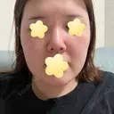 隆鼻術 / 鼻尖形成（切開） / 軟骨移植 エースクリニック 名古屋院 DAY 14 サムネイル用