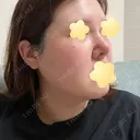 隆鼻術 / 鼻尖形成（切開） / 軟骨移植 エースクリニック 名古屋院 DAY 14 サムネイル用