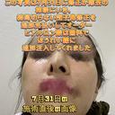 その他（鼻） / 鼻尖縮小 / 肌ヒアルロン酸注入（たるみ・シワ改善） / ヒアルロン酸注入（唇） / シワ取りボトックス / ヒアルロン酸注入（ほうれい線） 東京形成美容外科 船橋院 DAY 0 サムネイル用