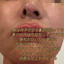 その他（鼻） / 鼻尖縮小 / 肌ヒアルロン酸注入（たるみ・シワ改善） / ヒアルロン酸注入（唇） / シワ取りボトックス / ヒアルロン酸注入（ほうれい線） 東京形成美容外科 船橋院 DAY 0 サムネイル用