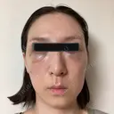 クマ治療 X CLINIC 銀座院 DAY 0 サムネイル用