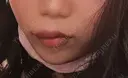 ヒアルロン酸注入（あご） / ボトックス（エラ・小顔） / ヒアルロン酸注入（唇） TCB東京中央美容外科 郡山院 DAY 3 サムネイル用
